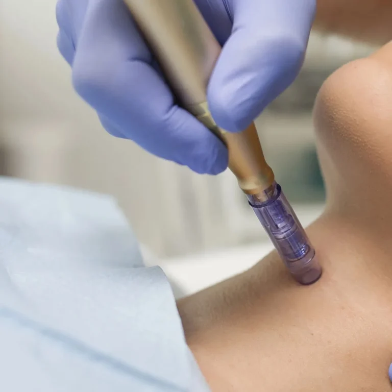 Nano Needling Facial Near Me in Frisco, TX | Nano Infusion Facial Near Me in Frisco, TX | Nano Channeling Facial