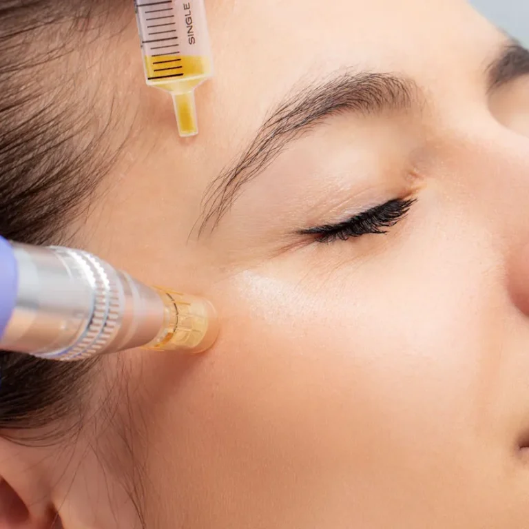 Nano Needling Facial Near Me in Frisco, TX | Nanoneedling Facial Near Me in Frisco, TX